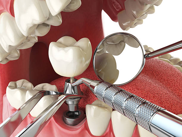 Best Emergency Denture Repair in Montoursville, PA